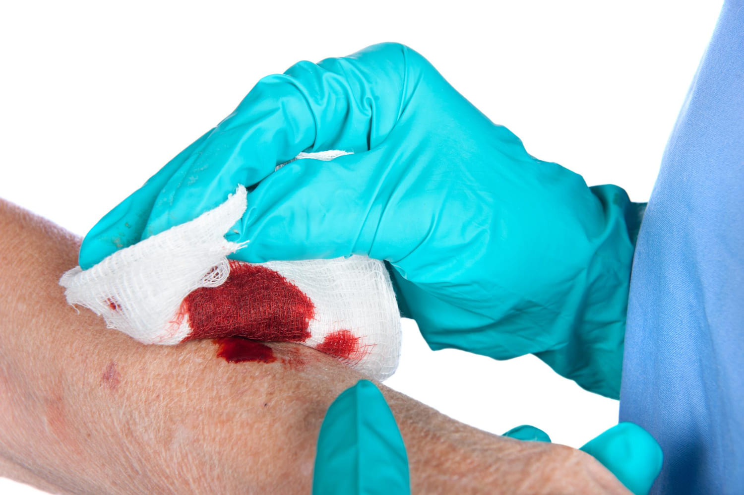 Heridas crónicas